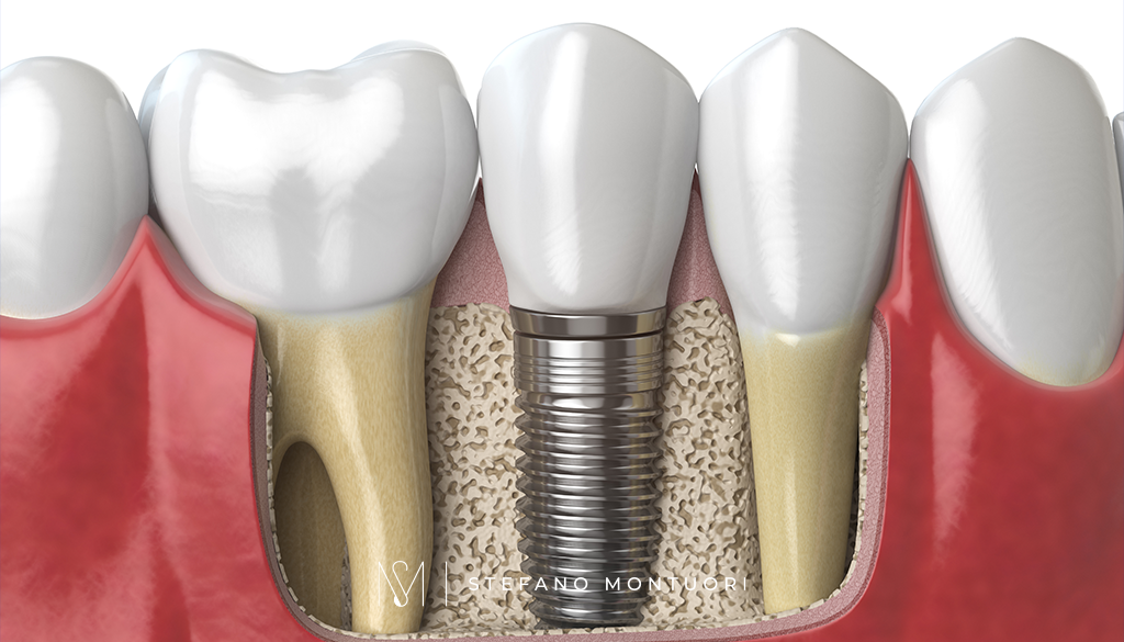 4 - Impianti dentali, tutto ciò che devi sapere