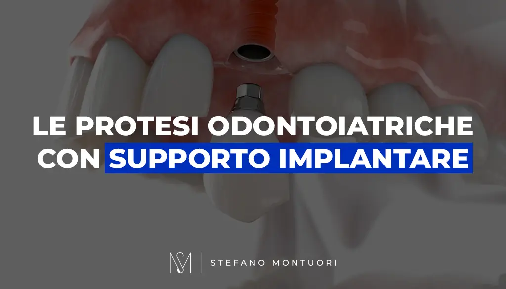 0cop_Le protesi odontoiatriche con supporto implantare